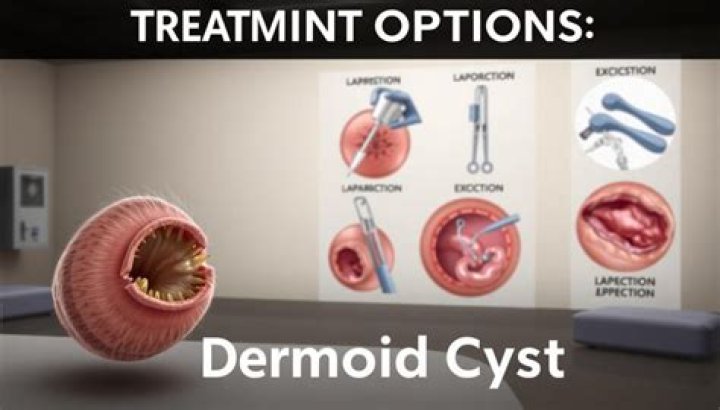 Are dermoid cysts common?