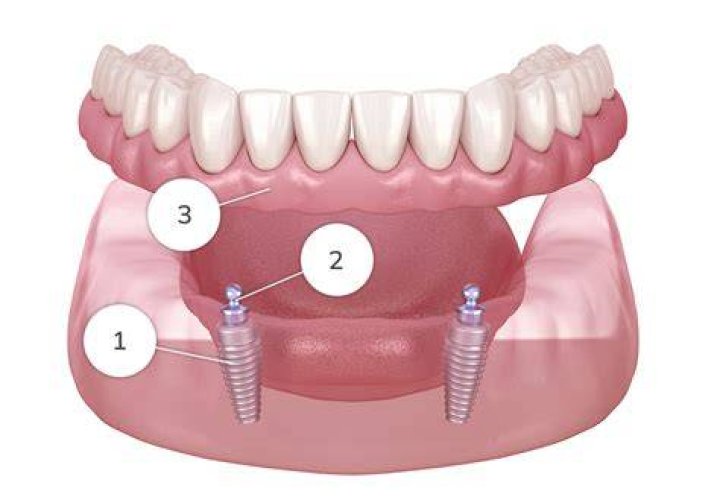 Are upper or lower dentures easier?