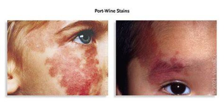 Can a birthmark be white?