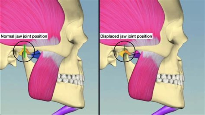 Can a dentist dislocate your jaw?