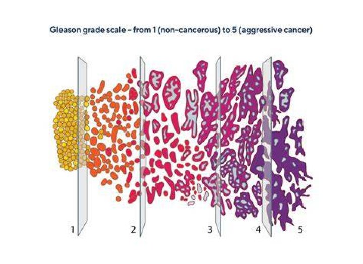 Can a Gleason 7 metastasize?