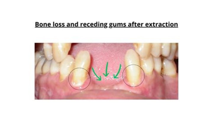 Can bone loss in gums be reversed?
