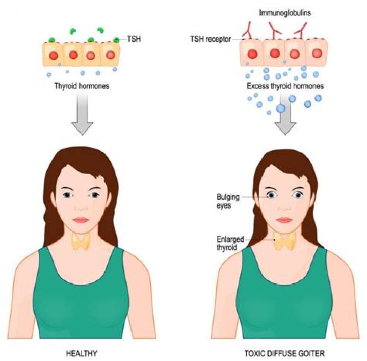 Can hypothyroidism cause eye problems?
