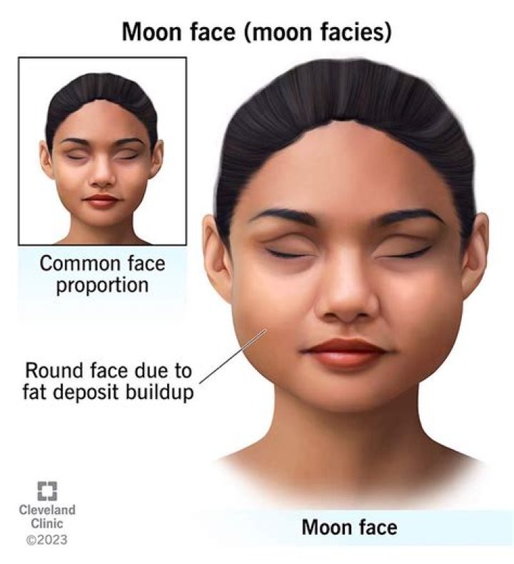 Can losing weight help rosacea?