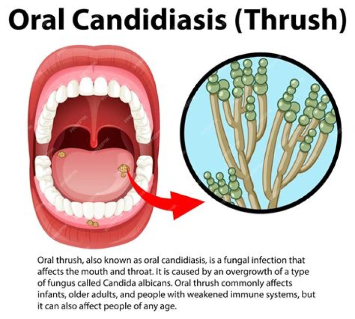 Can thrush cause flu like symptoms?