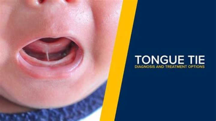 Can tongue-tie be corrected in adults?