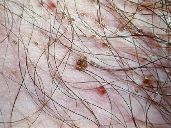 Can you see pubic lice?