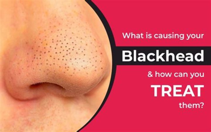 Do blackhead holes go away?
