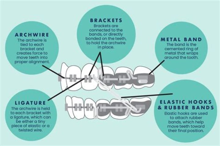 Do orthodontists reuse braces?