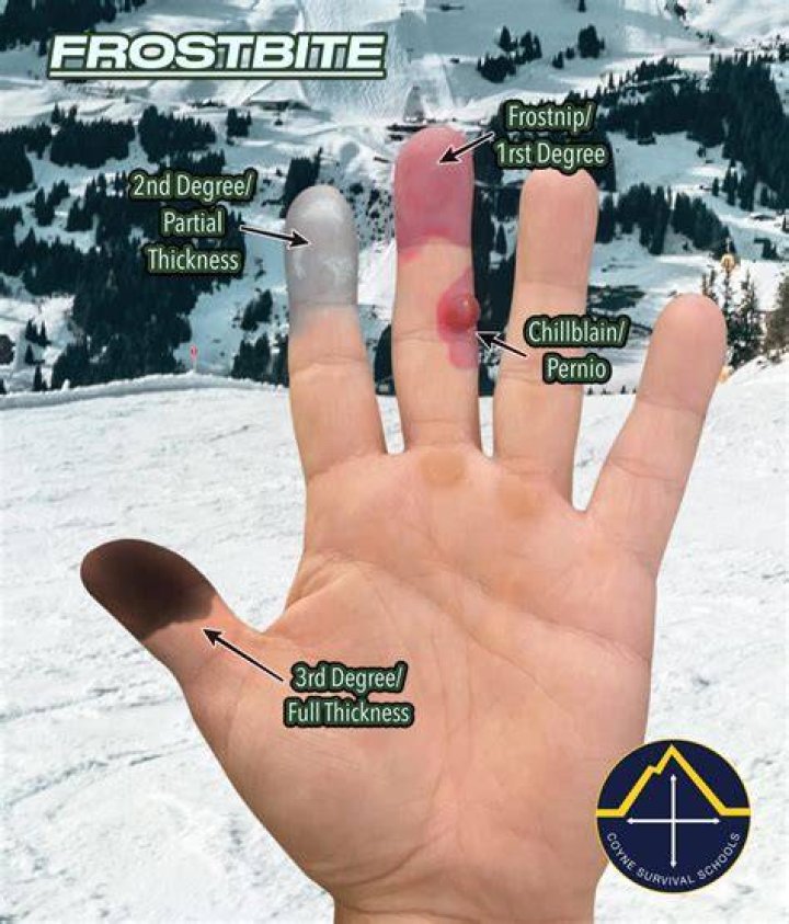 Do your fingers get skinnier in the winter?
