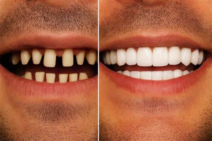 Do your teeth explode when cremated?
