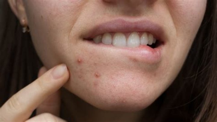 Does egg white cause pimples?