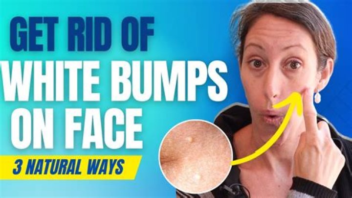 Does egg white get rid of pimples?