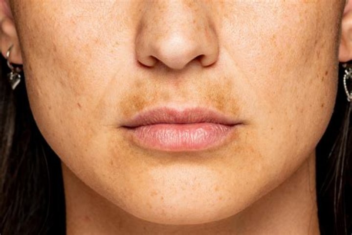 Does Fraxel cause hyperpigmentation?