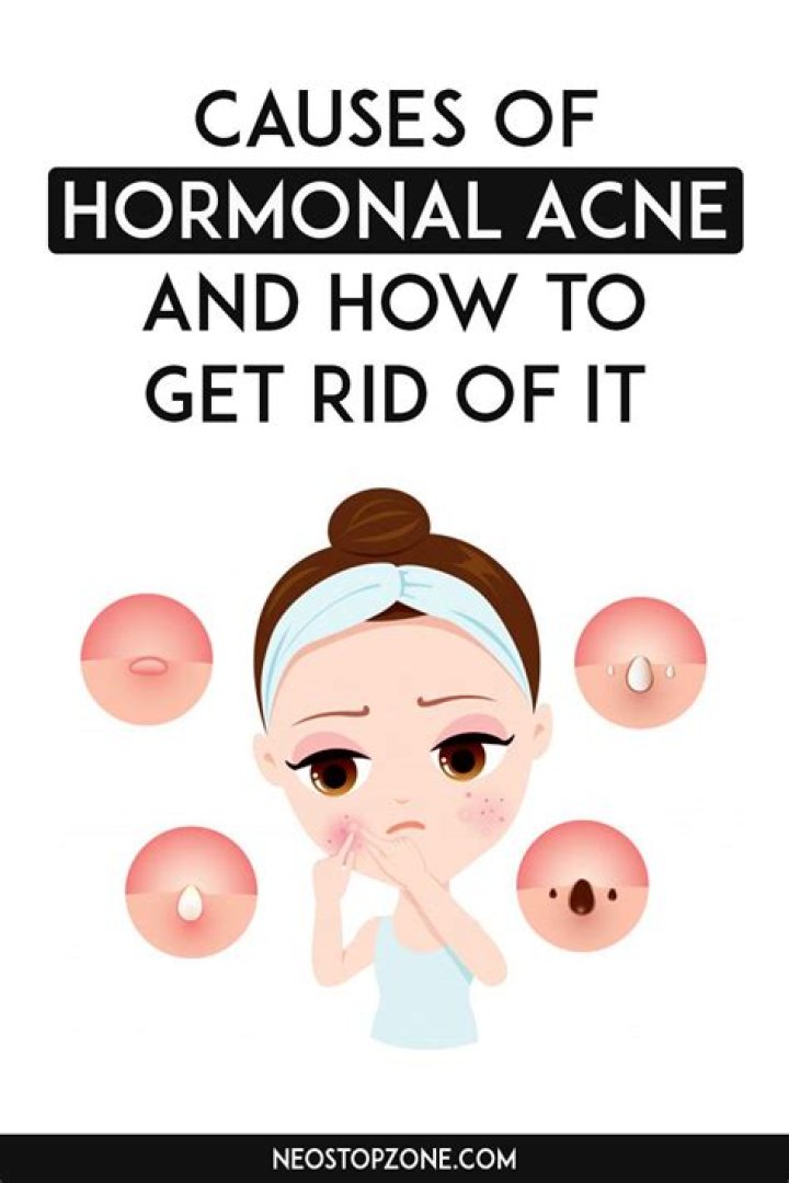 Does hormonal acne go away?