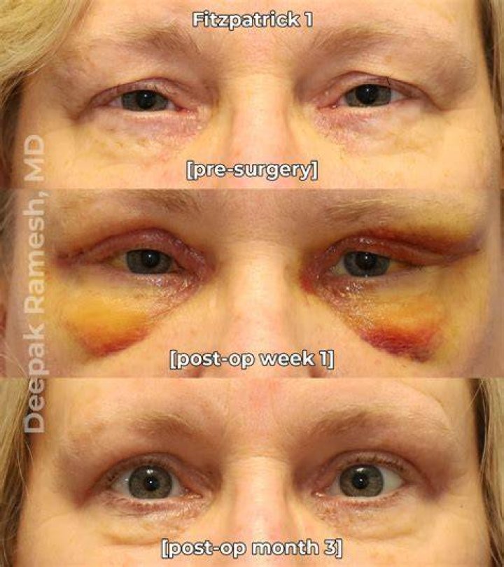 Does upper blepharoplasty change shape?
