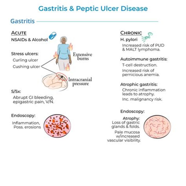 How can you tell the difference between an ulcer and gastritis?