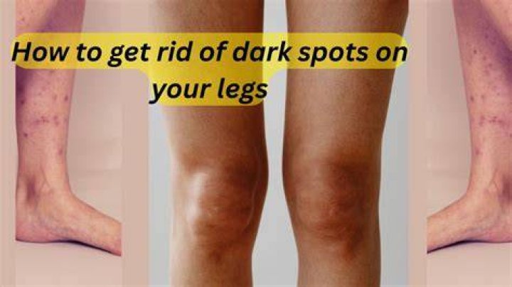 How do you get rid of dark spots on your legs?