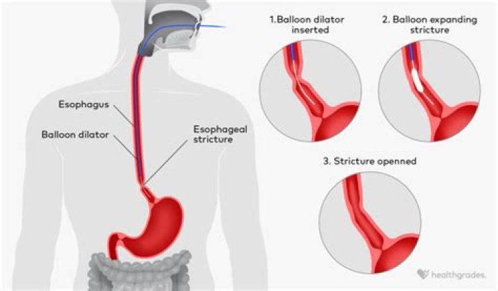 How do you know if your esophagus is bleeding?
