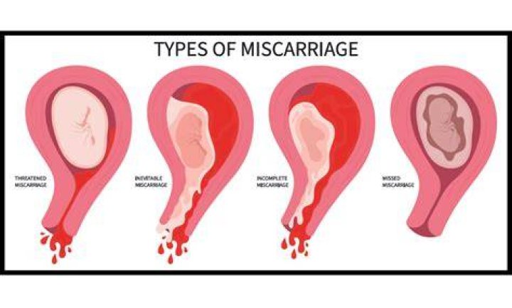 How long does a miscarriage take?
