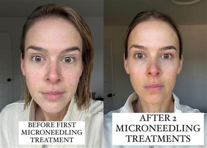 How long does microneedling last for wrinkles?