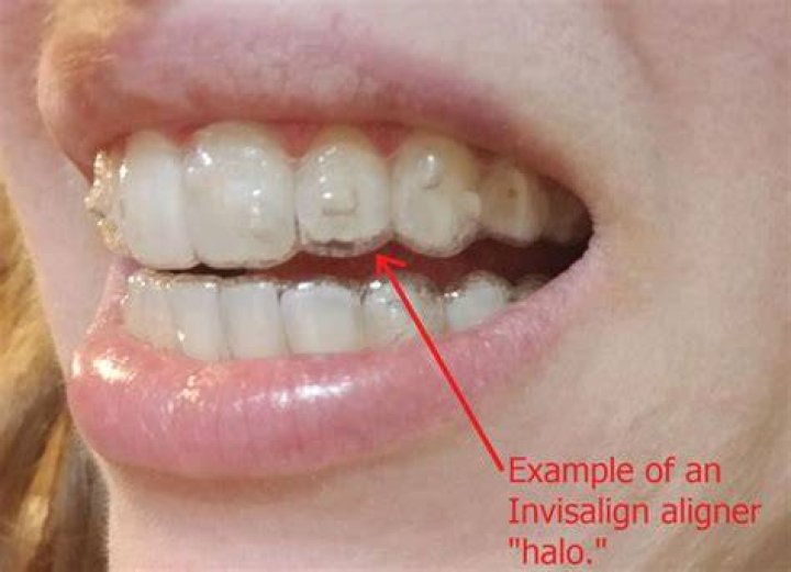 How often should I chew chewies with Invisalign?