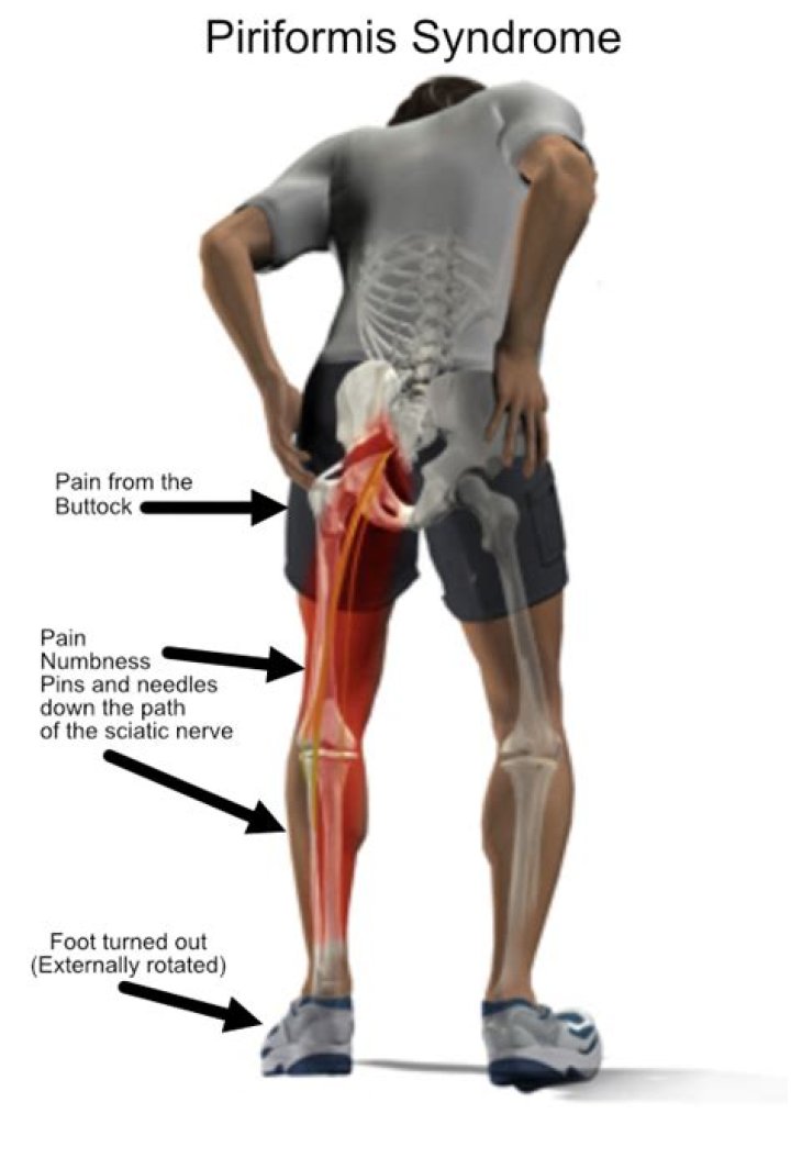 Is cycling good for piriformis syndrome?