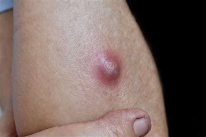 Is it staph or a pimple?