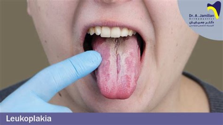 Is leukoplakia usually harmless?