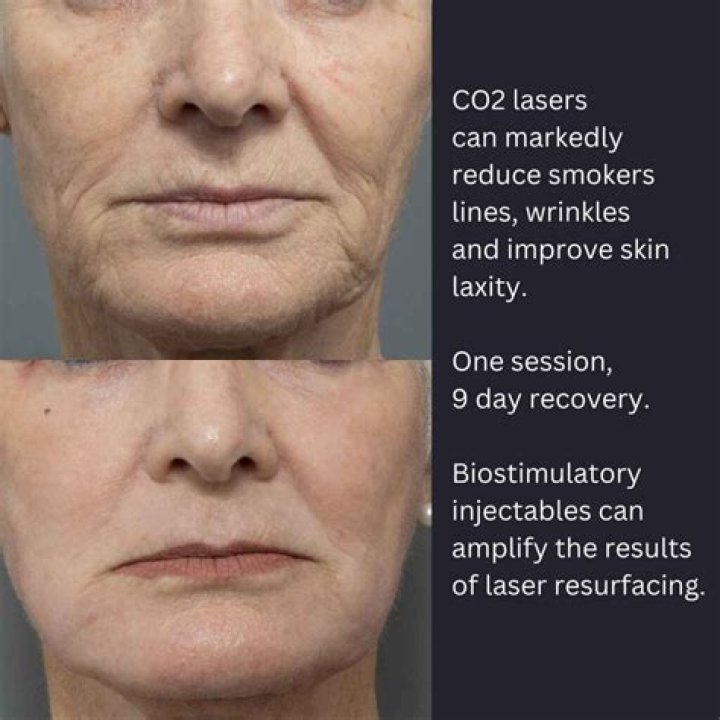 What can go wrong with CO2 laser?
