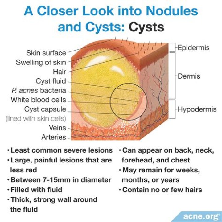 What do cysts smell like?