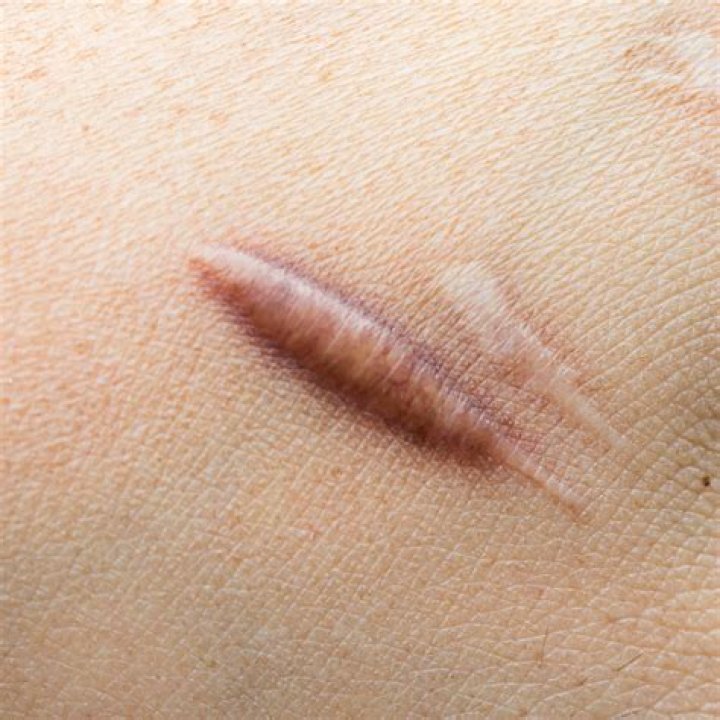 What do keloid scars look like?