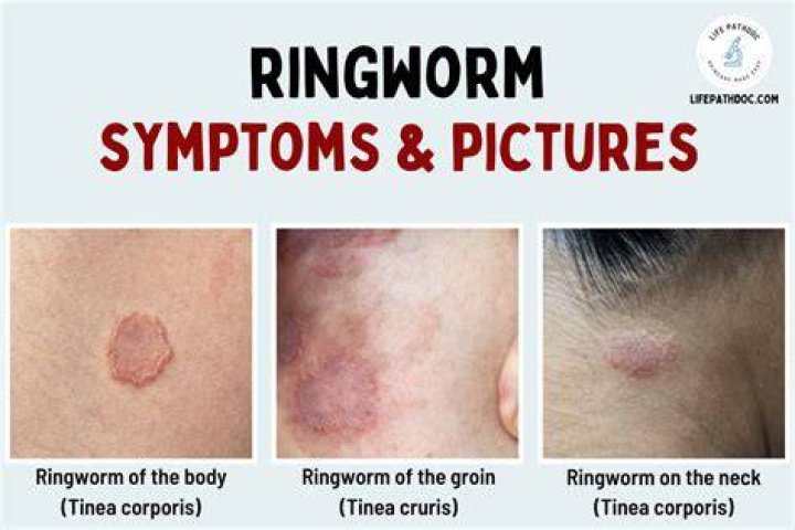 What does a ringworm look like?