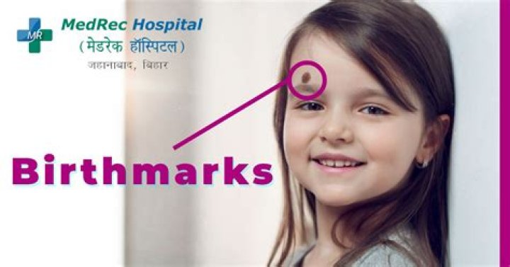What is a cherry birthmark?