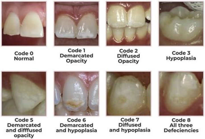 What is a shovel tooth?