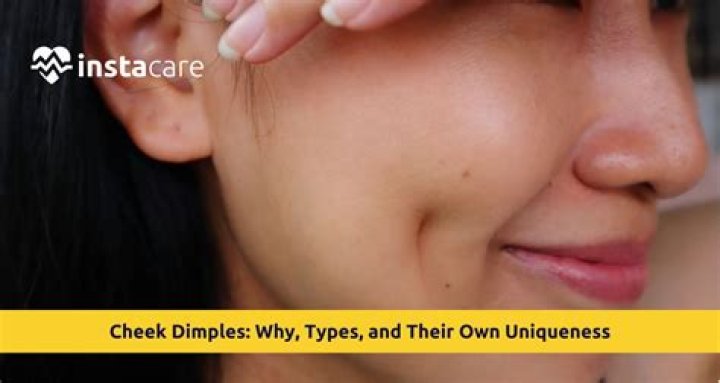 What is the rarest dimple type?