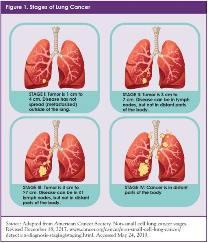 What stage is a 2 cm lung tumor?