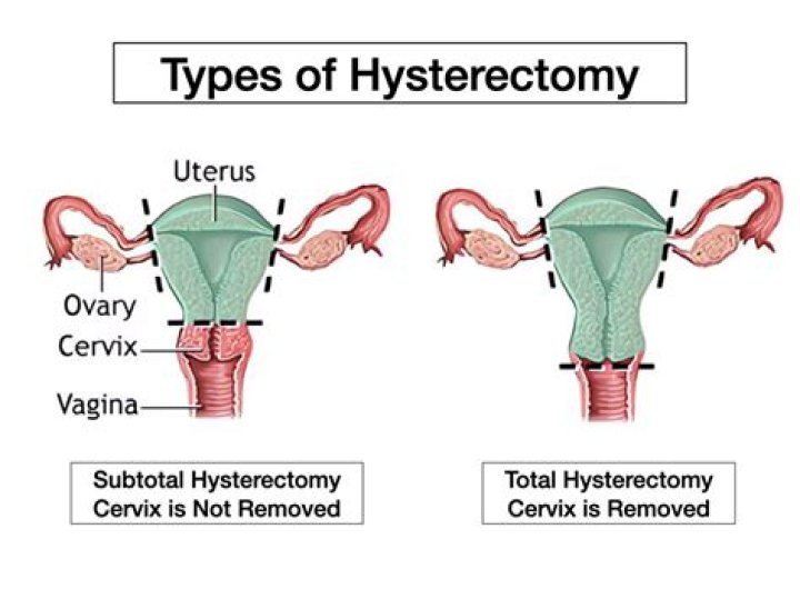 When does swelly belly go away after hysterectomy?