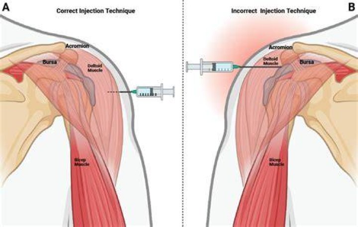 Which vein is used for injection?