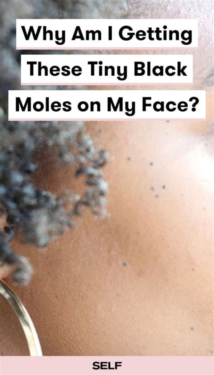 Why am I getting tiny black moles on my face?