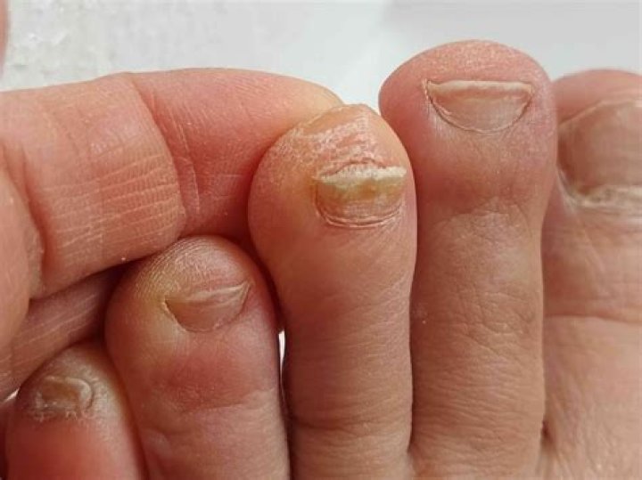Why do I rip my toenails?