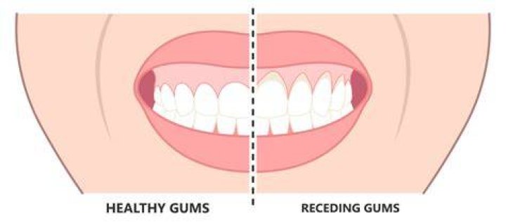 Why is my gum separating from my tooth?